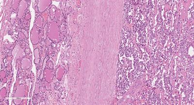 Is Encapsulated Medullary Thyroid Carcinoma Associated With a Better Prognosis? A Case Series and a Review of the Literature